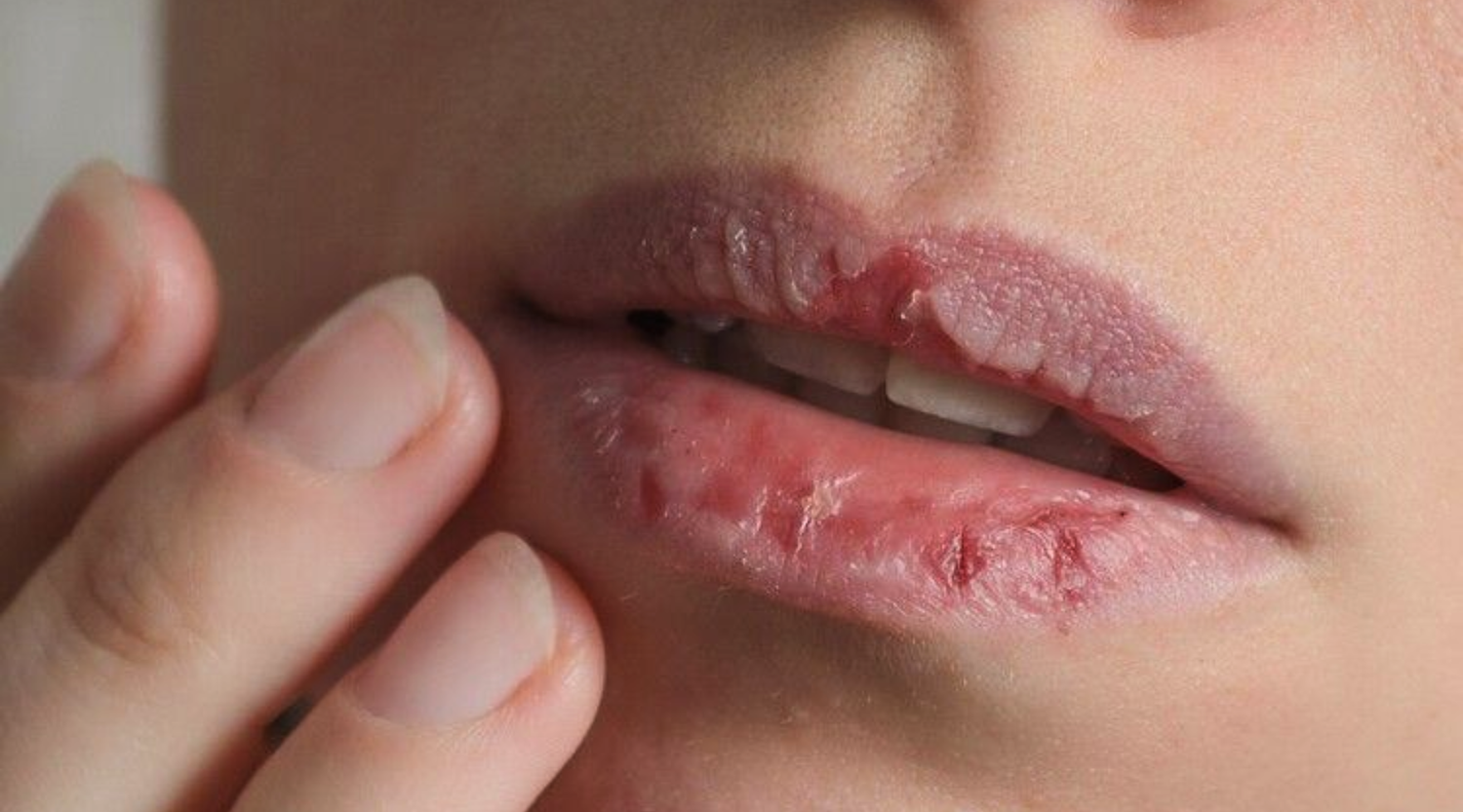 Winter Skincare Mistakes to Avoid According to a Dermatologist